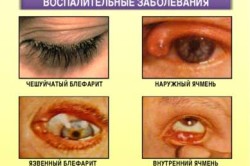 Воспалительные заболевания - причина слезоточивости глаз