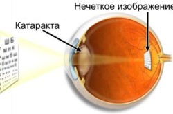Схема катаракты глаза