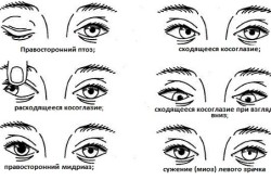Симптомы поражения глазодвигательных нервов