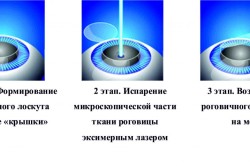 Этапы лазерной коррекции зрения