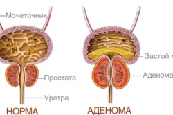 Аденома простаты - причина возникновения пиелонефрита