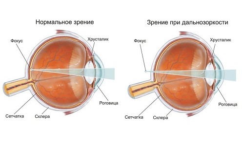 Нормальное зрение и зрение при дальнозоркости