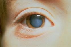 Здоровый хрусталик глаза и катаракта