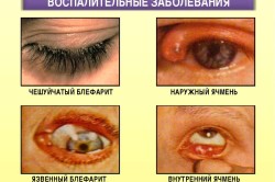 Заболевания глаз, вызывающие их покраснение