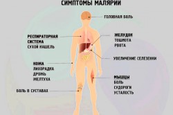 Симптомы малярии