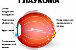 Глазная болезнь глаукома
